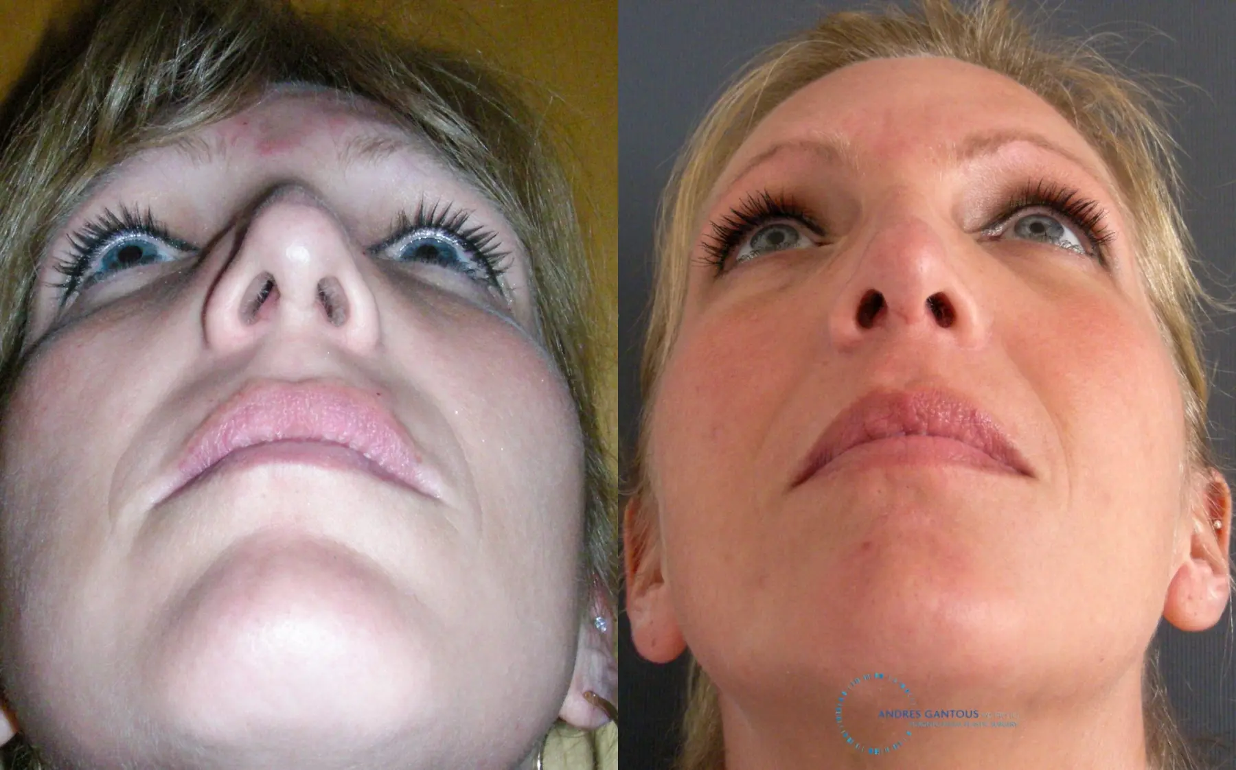 Revision Rhinoplasty: Patient 16 - Before and After 2
