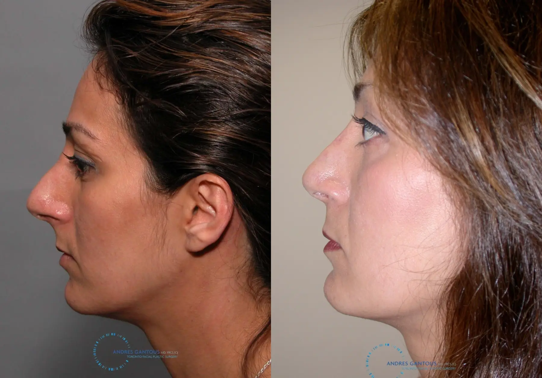 Revision Rhinoplasty: Patient 17 - Before and After 4