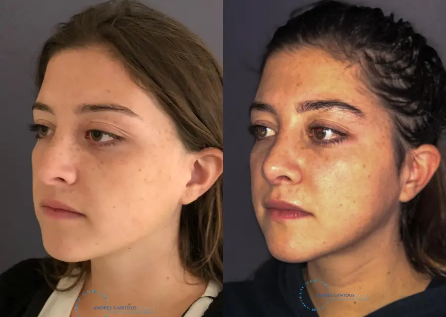 Revision Rhinoplasty: Patient 21 - Before and After 3