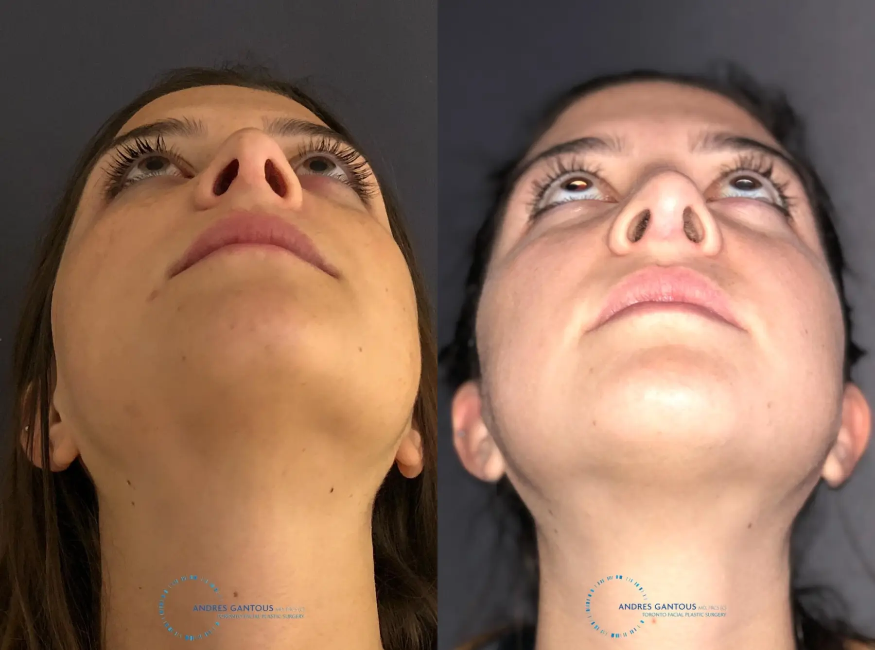 Revision Rhinoplasty: Patient 21 - Before and After 2
