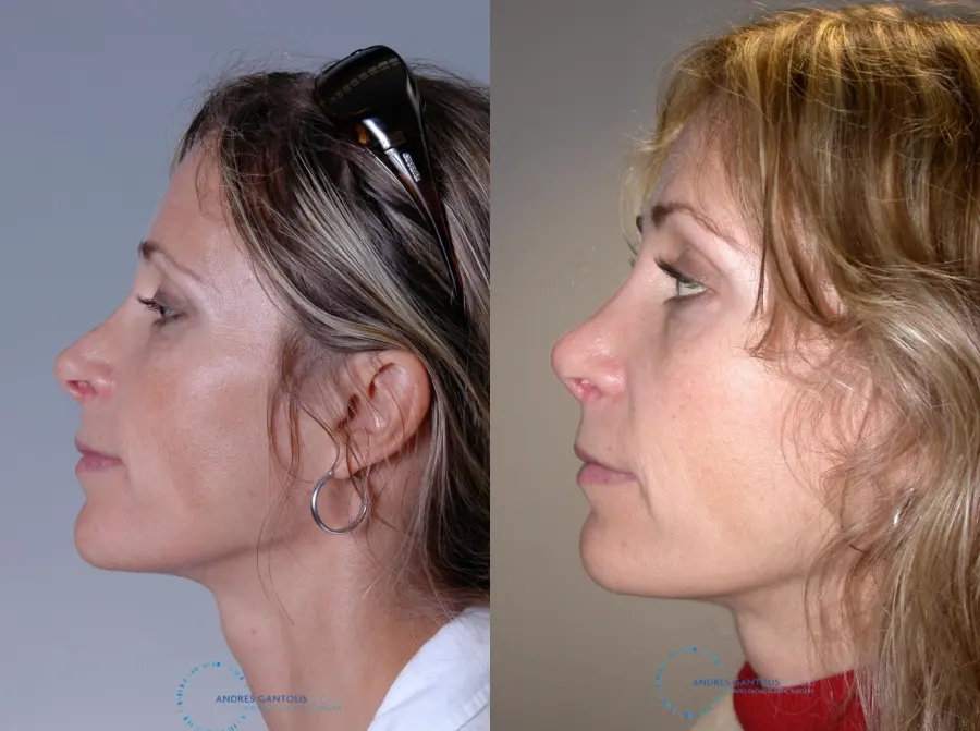 Revision Rhinoplasty: Patient 19 - Before and After 4