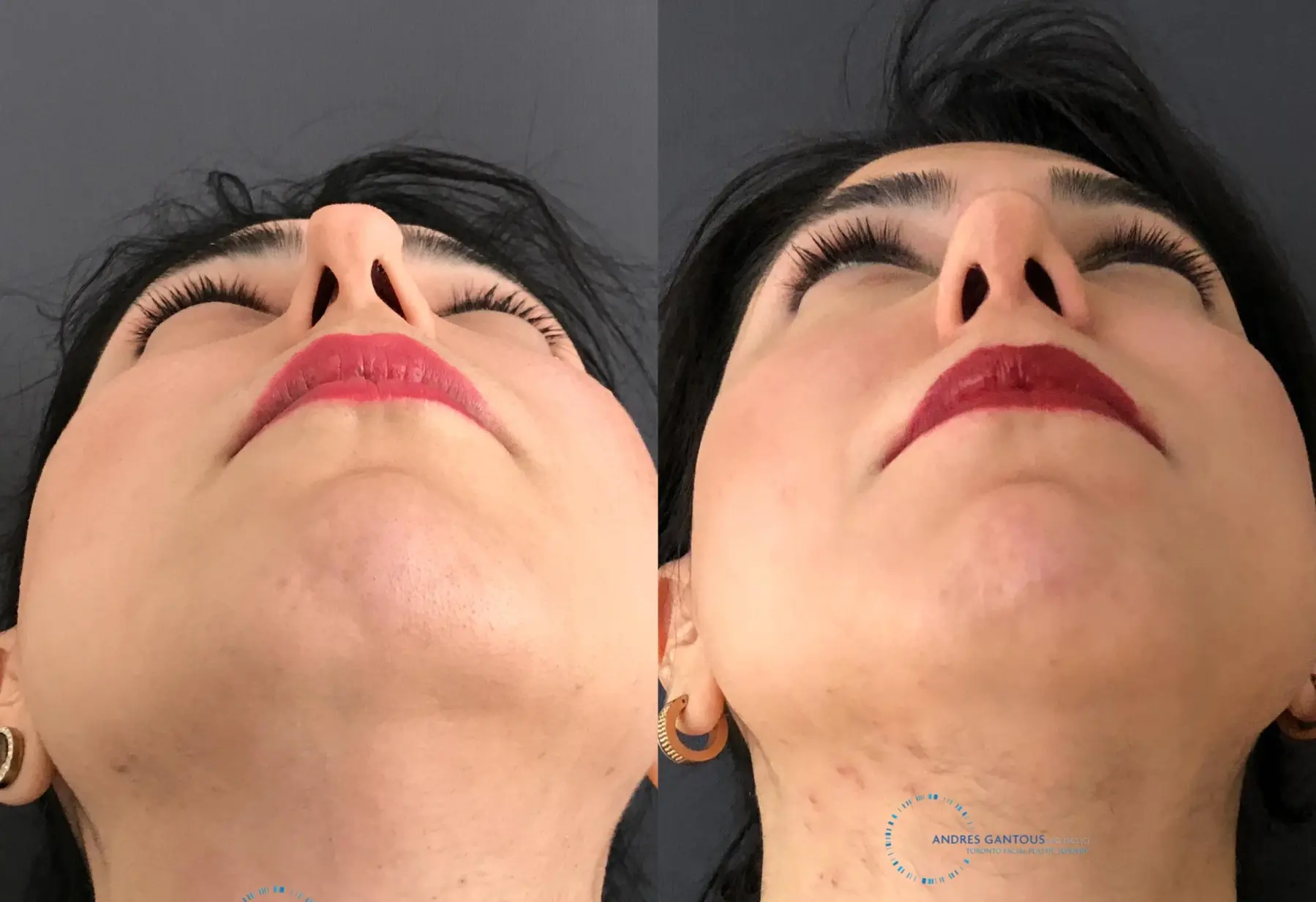 Revision Rhinoplasty: Patient 18 - Before and After 2