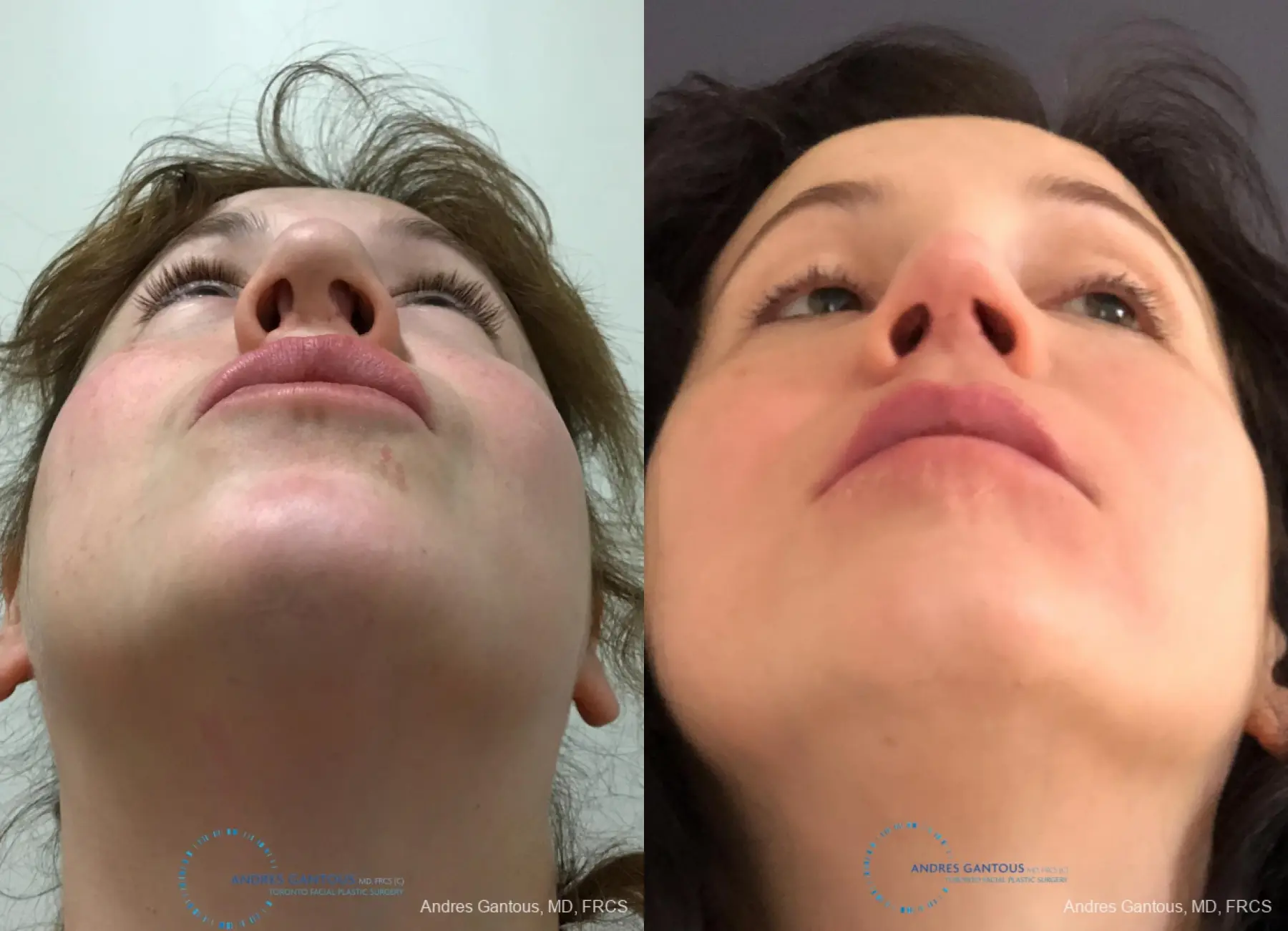 Revision Rhinoplasty: Patient 9 - Before and After 2