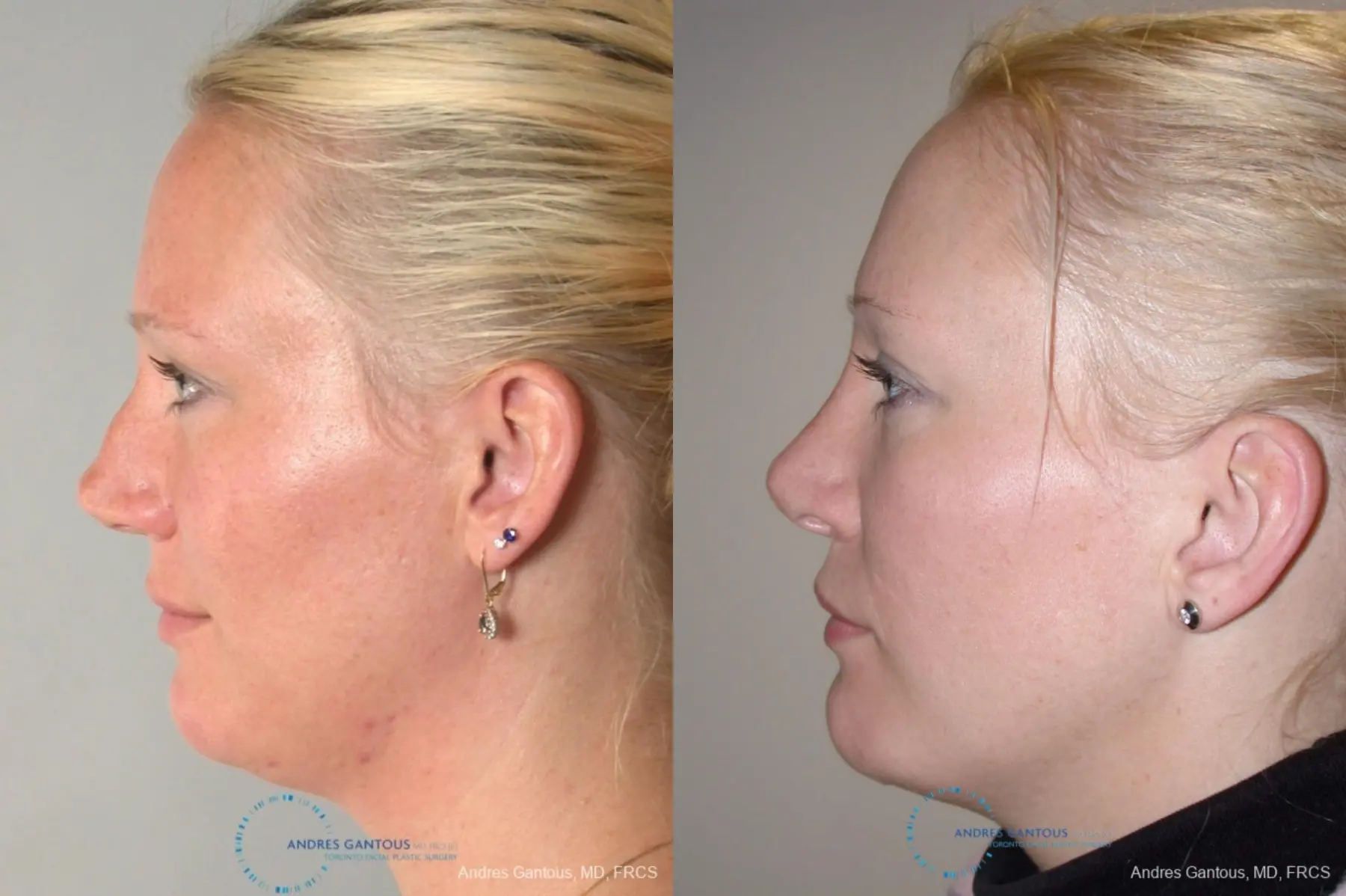 Rhinoplasty: Patient 94 - Before and After 4