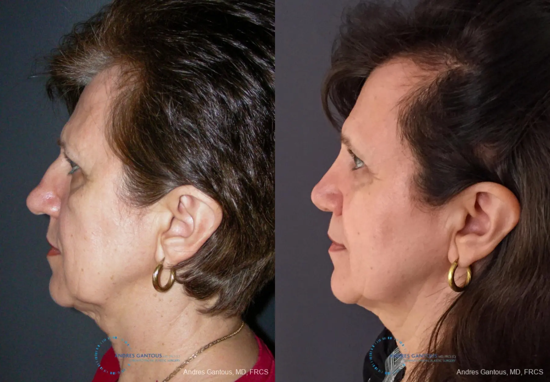 Rhinoplasty: Patient 95 - Before and After 6