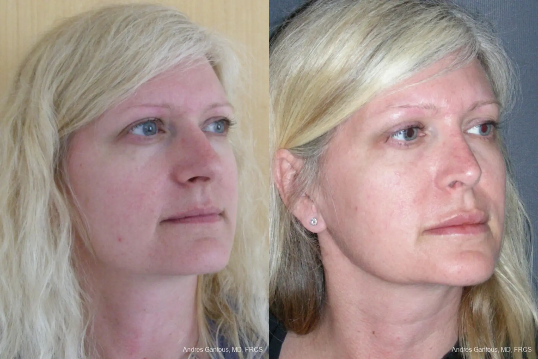 Rhinoplasty: Patient 44 - Before and After 2