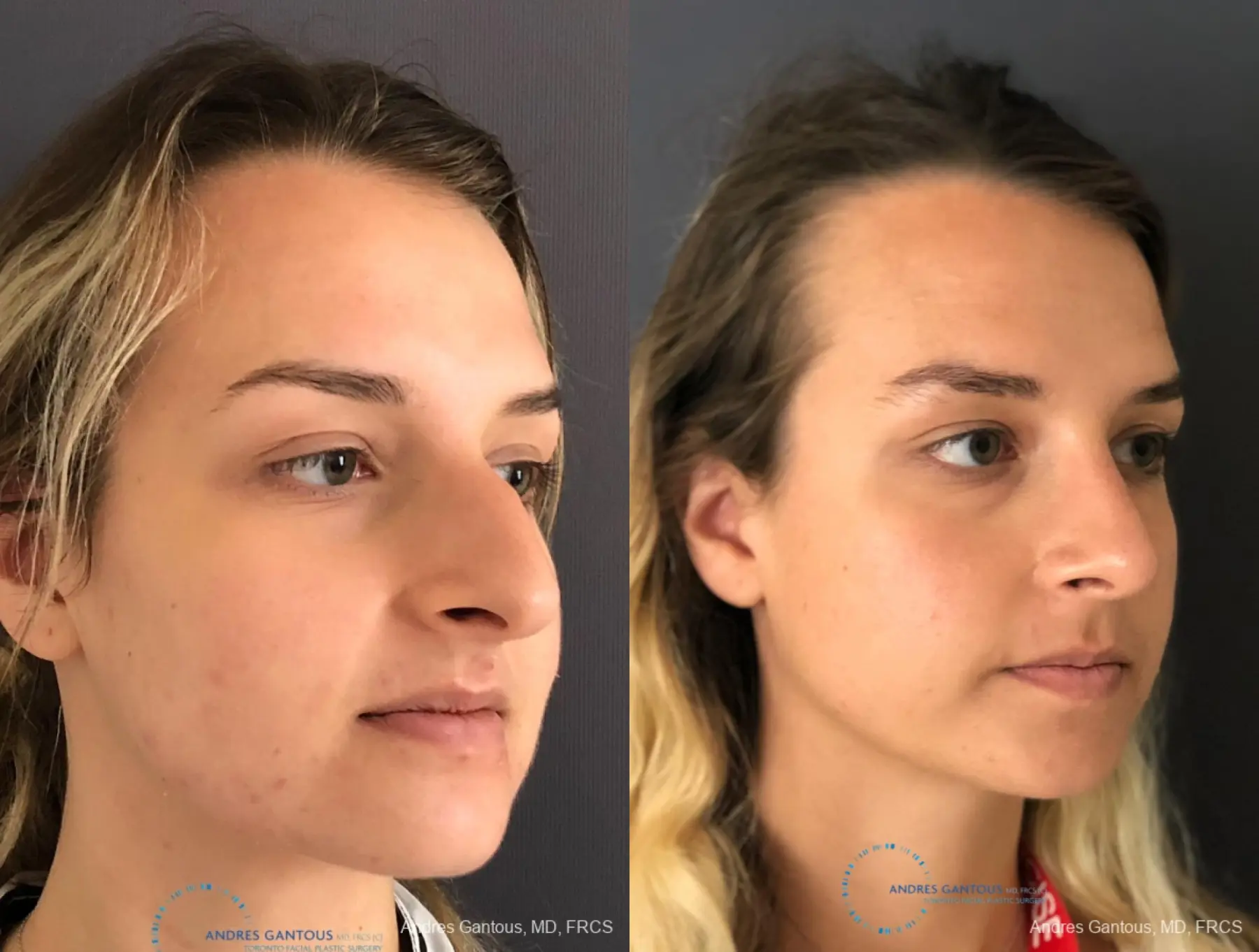 Rhinoplasty: Patient 86 - Before and After 3