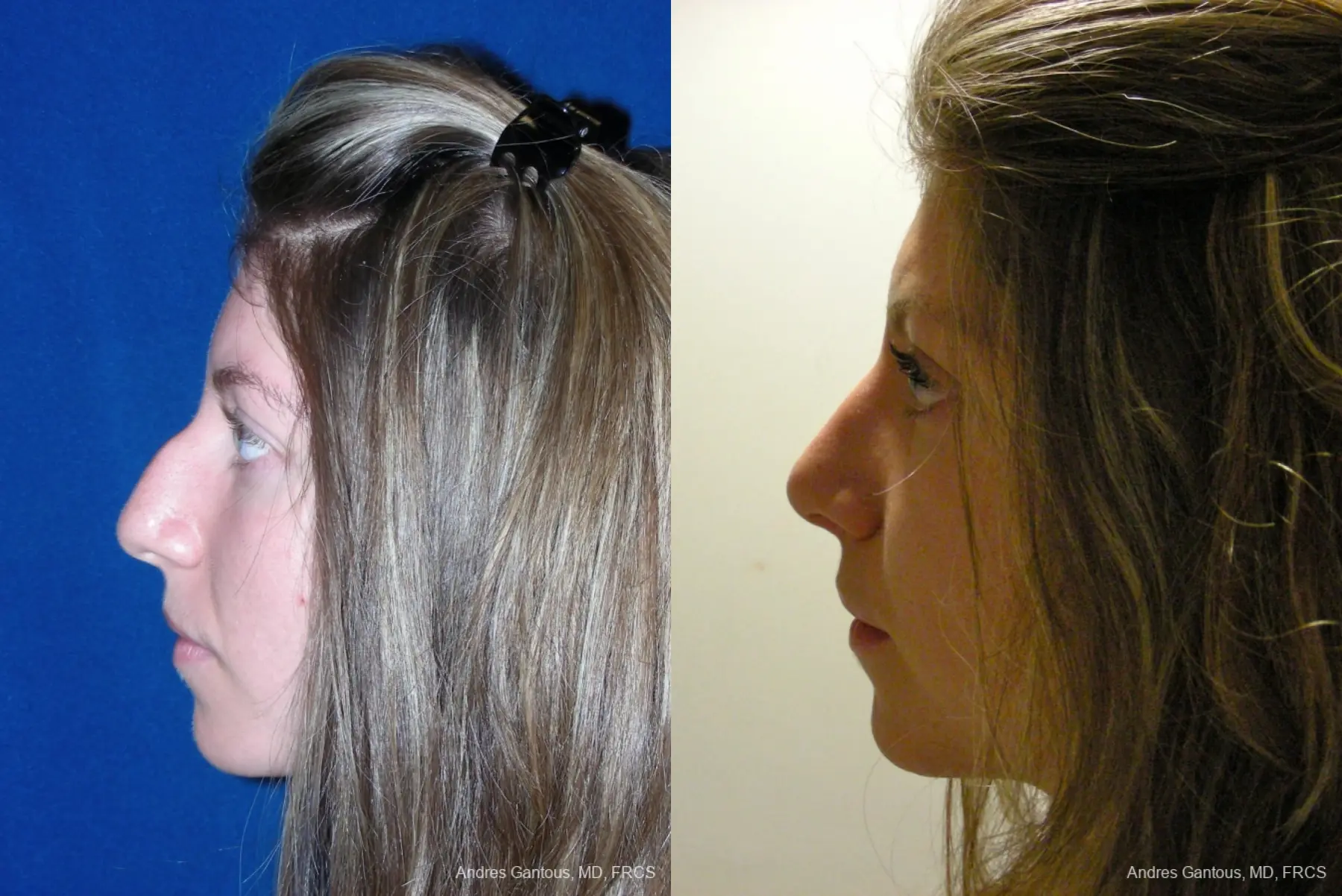 Rhinoplasty: Patient 50 - Before and After 3