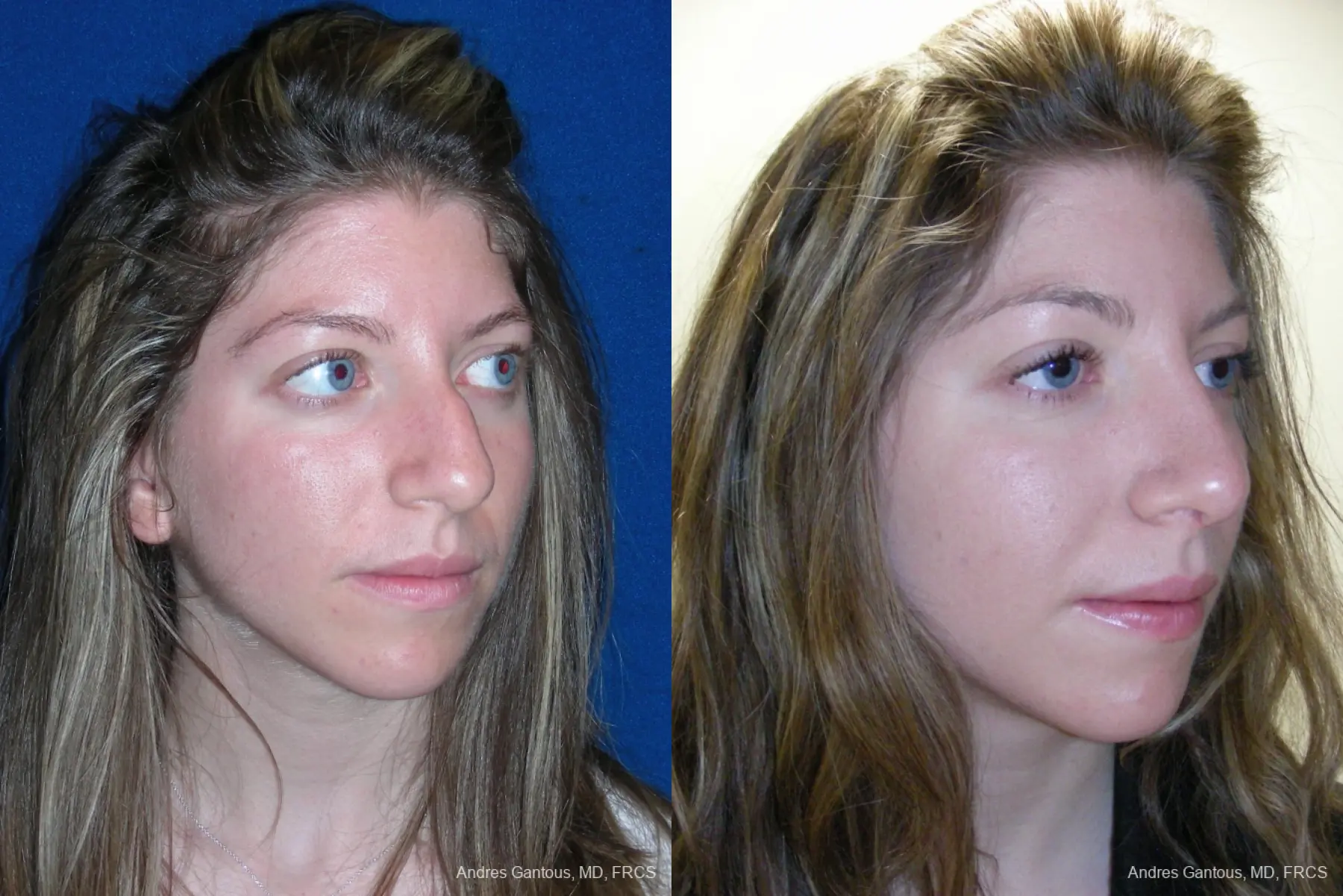 Rhinoplasty: Patient 50 - Before and After 4