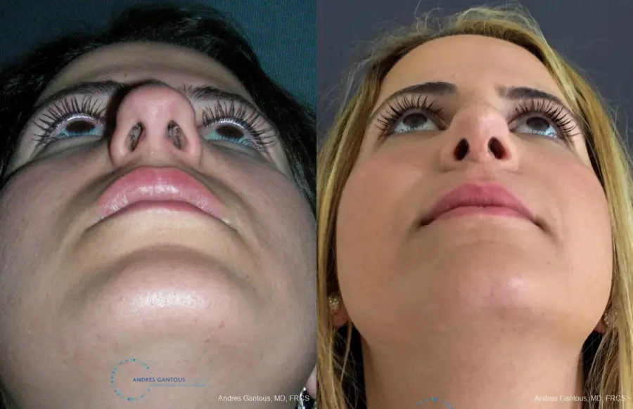 Rhinoplasty: Patient 92 - Before and After 2