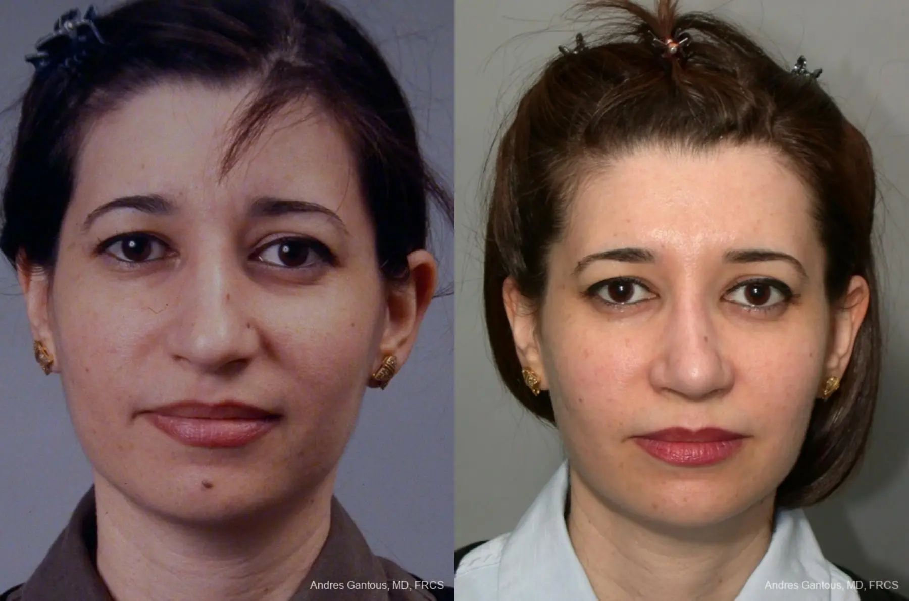 Rhinoplasty: Patient 41 - Before and After 1