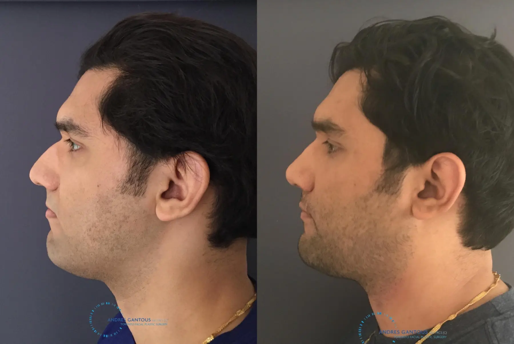 Rhinoplasty: Patient 62 - Before and After 6