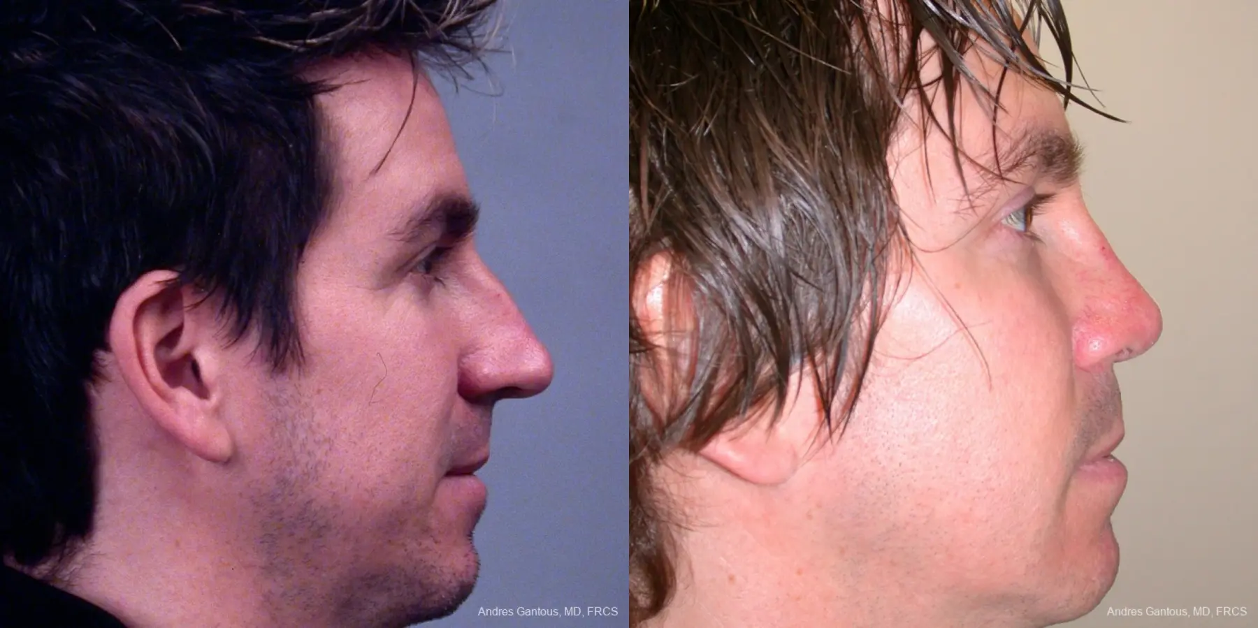 Rhinoplasty: Patient 39 - Before and After 4