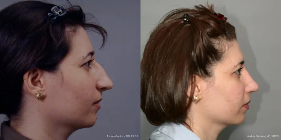 Rhinoplasty: Patient 41 - Before and After 4