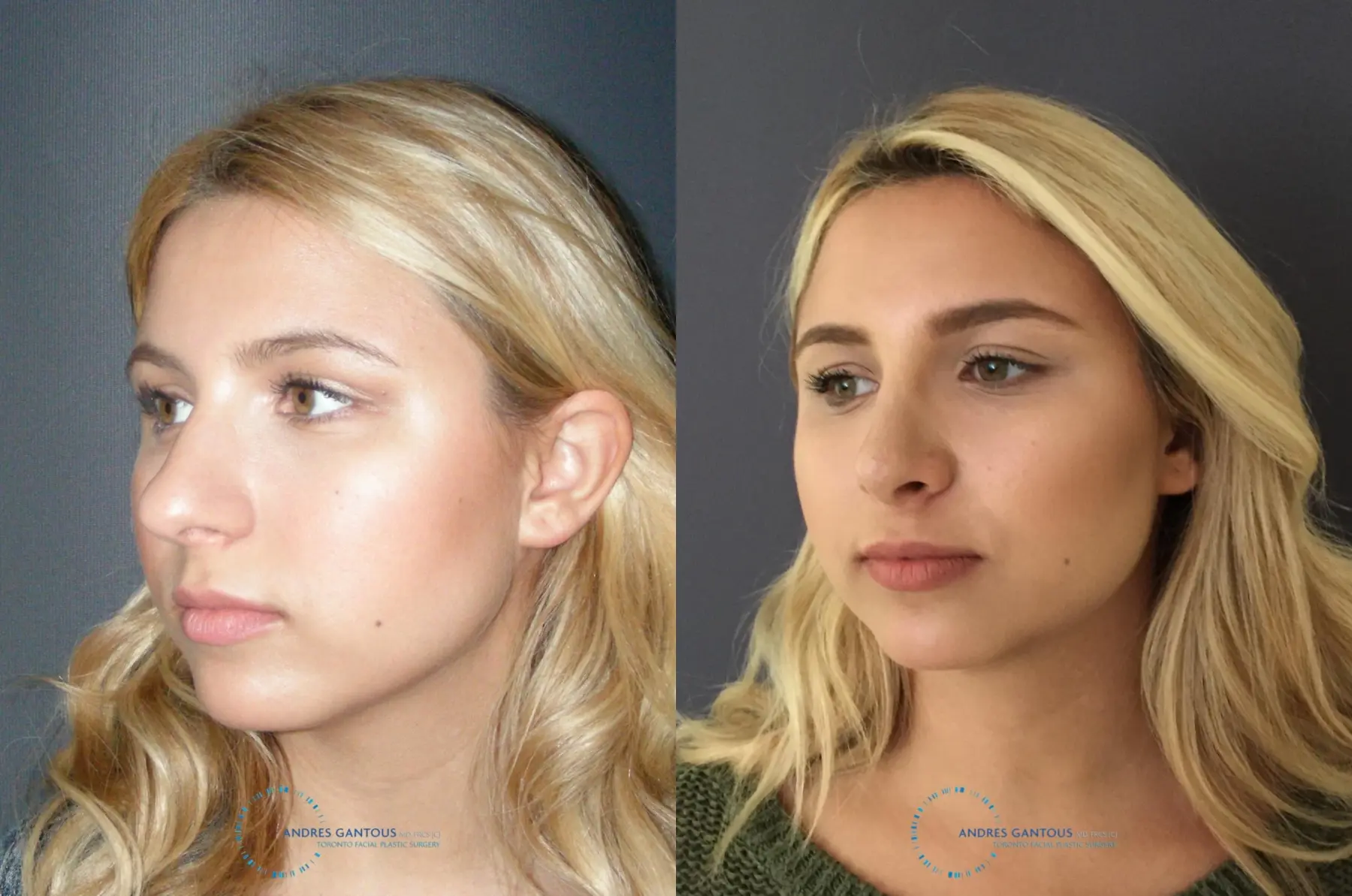 Rhinoplasty: Patient 70 - Before and After 4