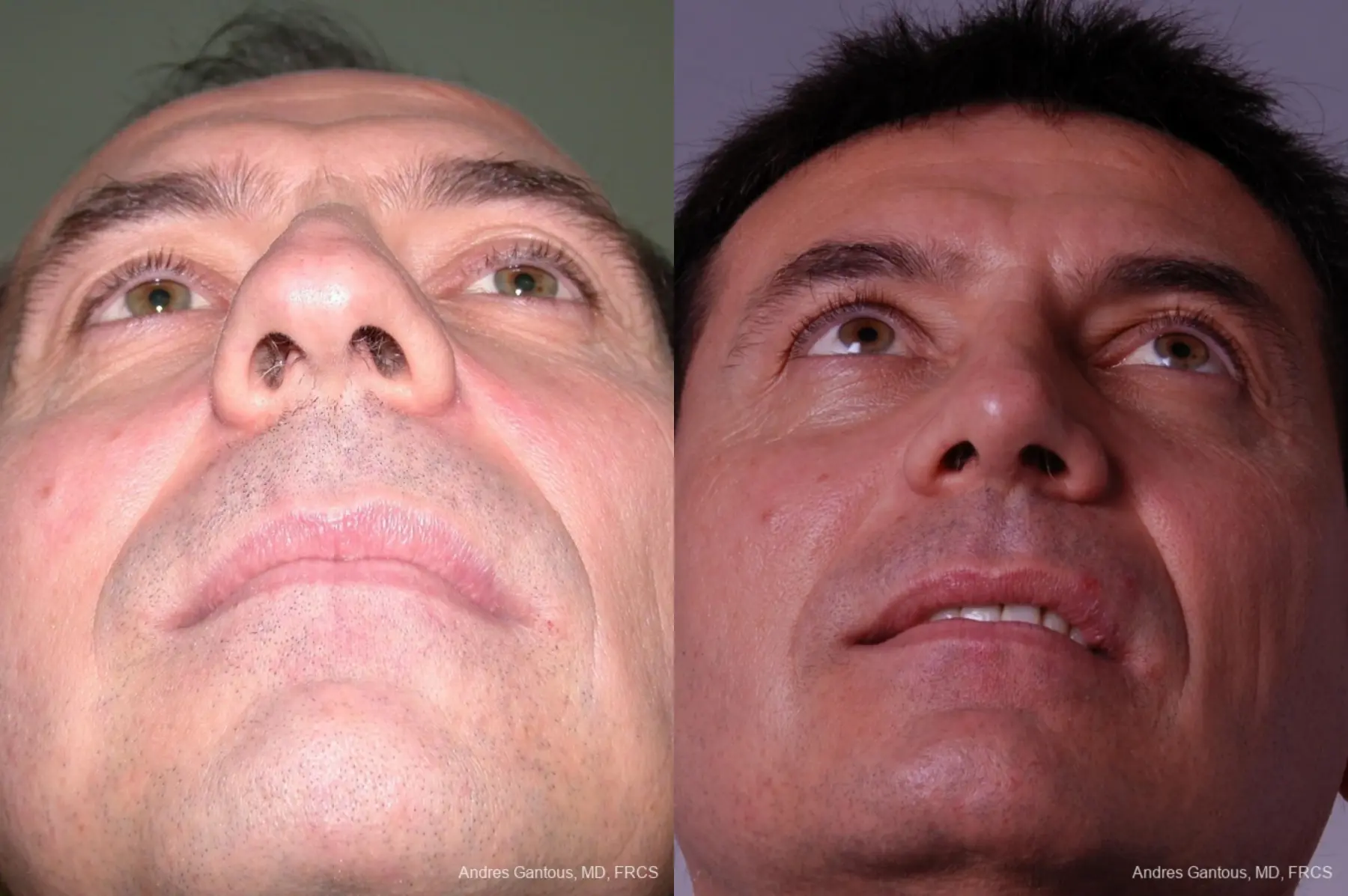 Rhinoplasty: Patient 10 - Before and After 4