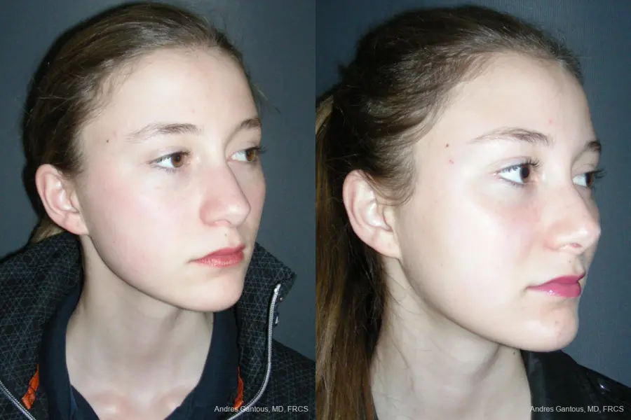 Rhinoplasty: Patient 55 - Before and After 2
