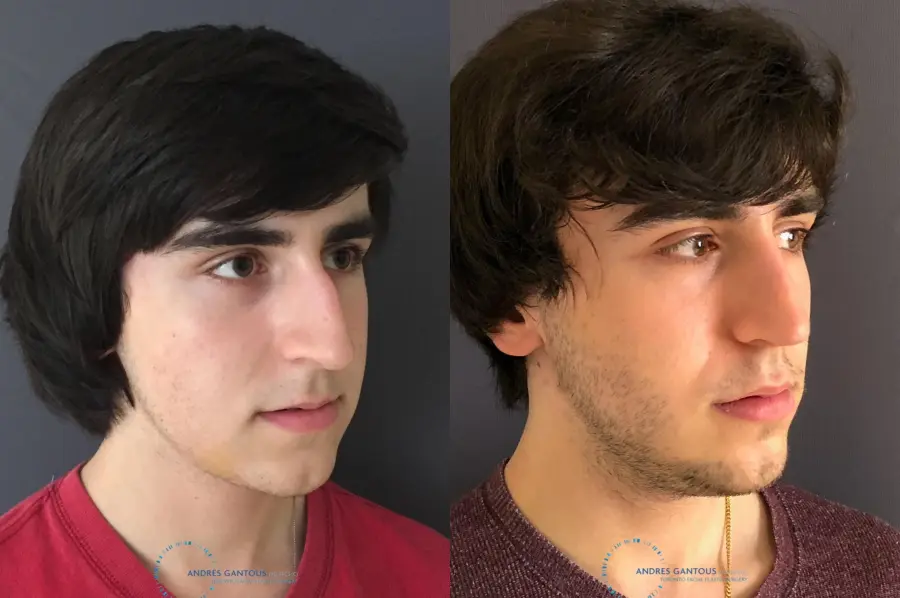 Rhinoplasty: Patient 67 - Before and After 3
