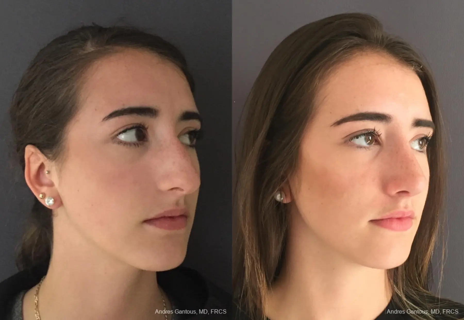Rhinoplasty: Patient 95 - Before and After 3