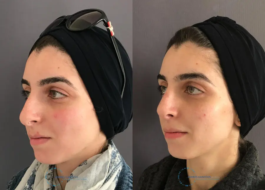 Rhinoplasty: Patient 58 - Before and After 4