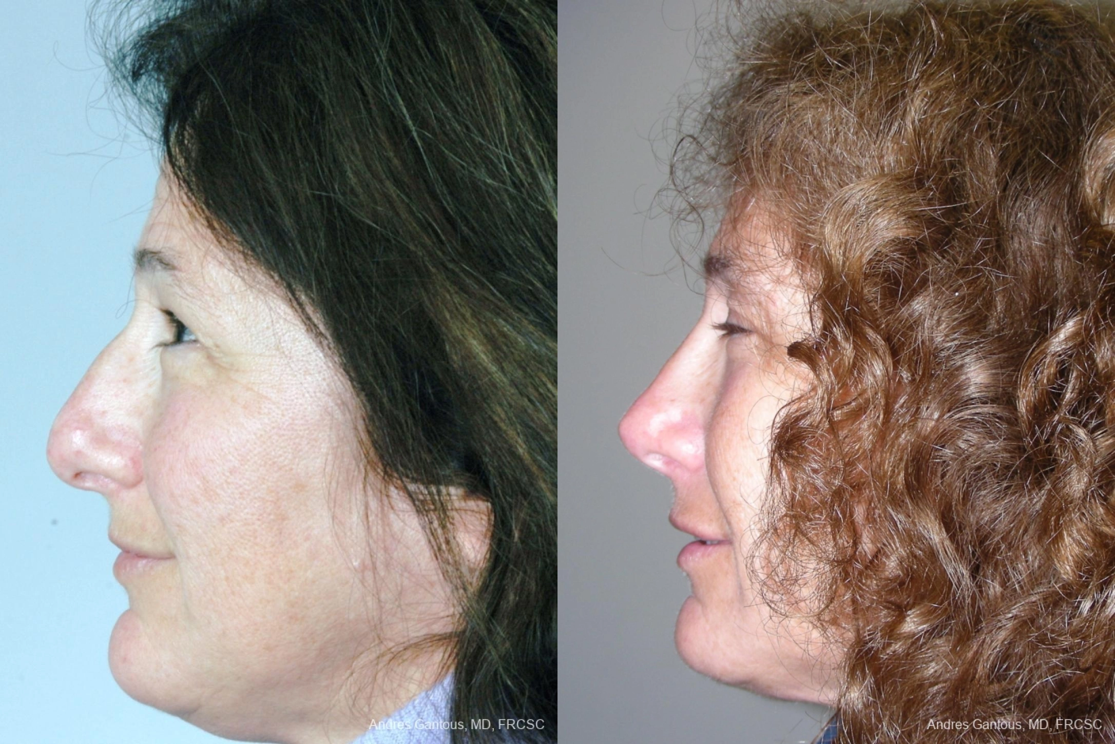 Rhinoplasty - Thumbnail 3