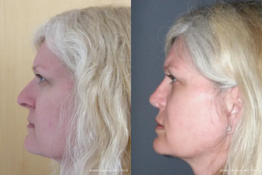 Rhinoplasty: Patient 44 - Before and After 5
