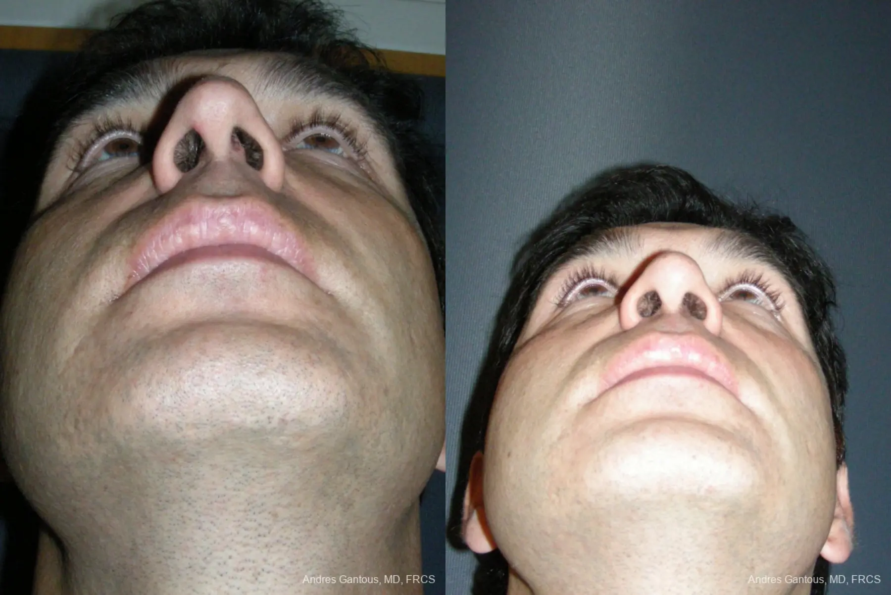 Rhinoplasty: Patient 43 - Before and After 6