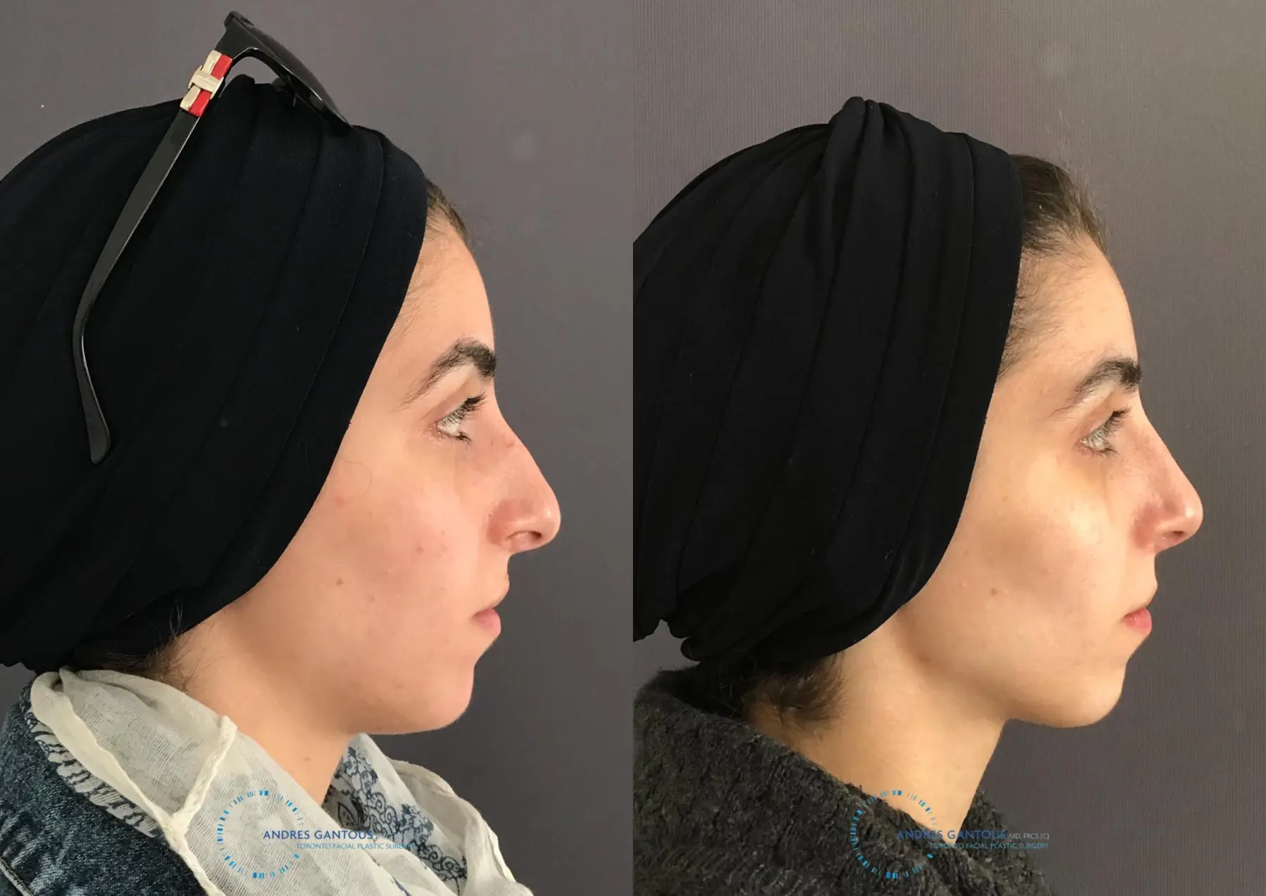 Rhinoplasty: Patient 58 - Before and After 5