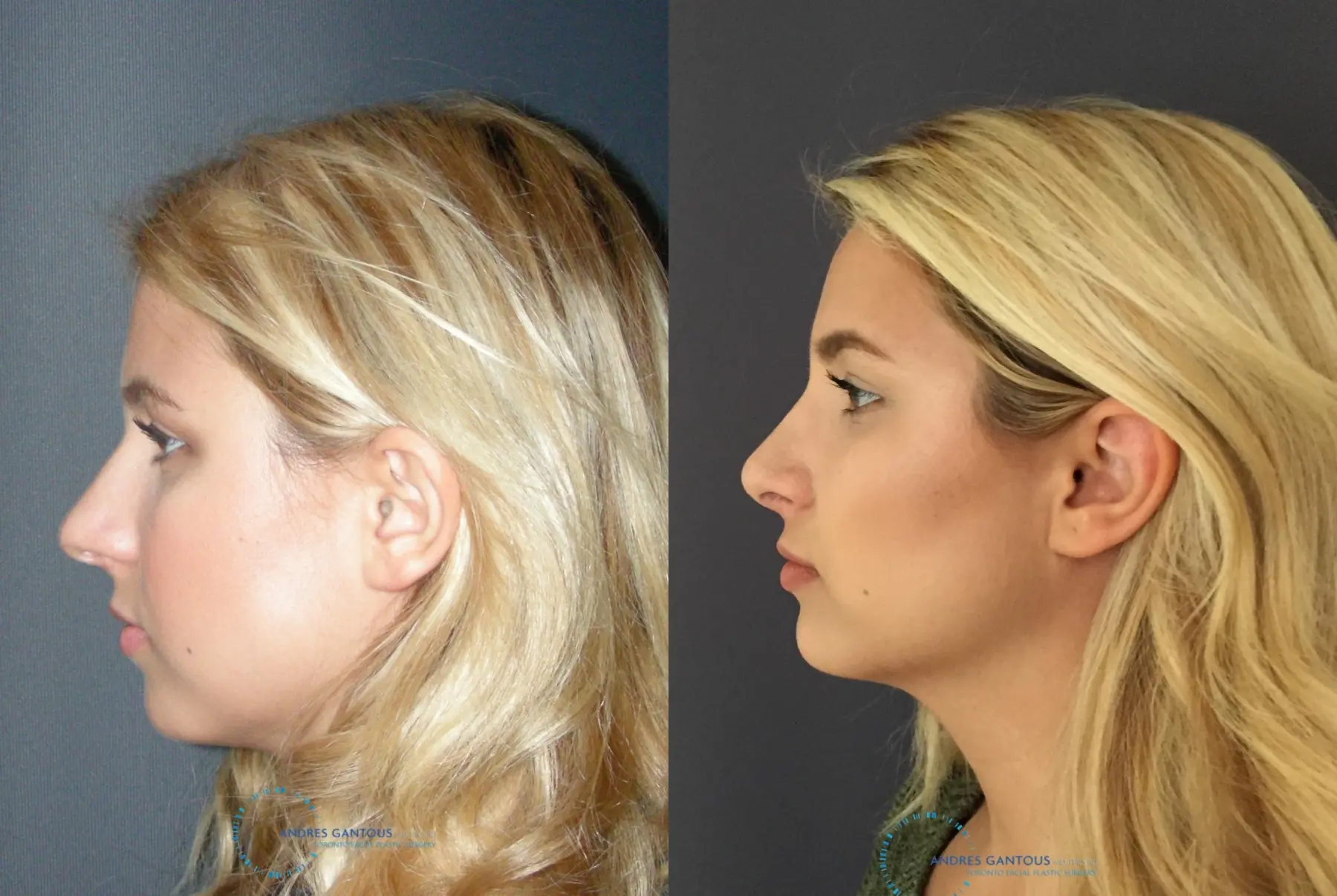 Rhinoplasty: Patient 70 - Before and After 6