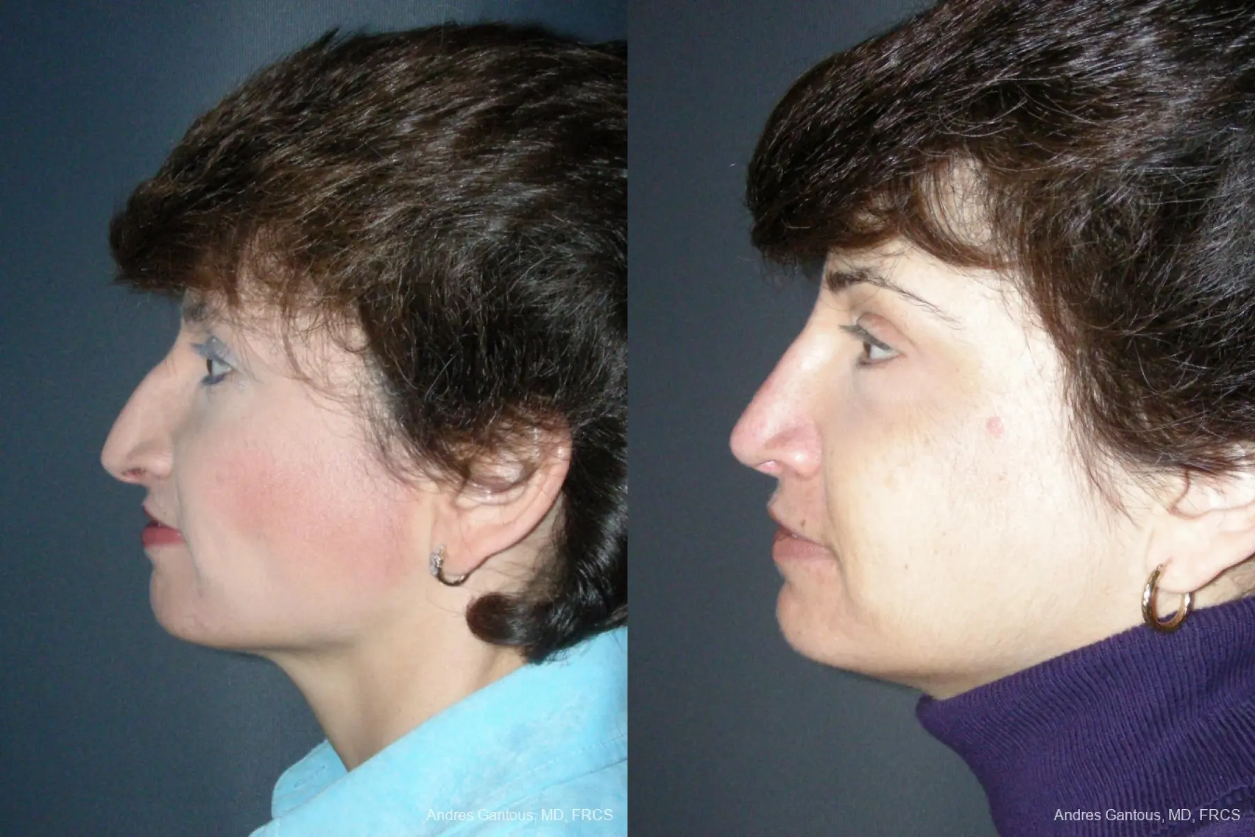 Rhinoplasty: Patient 49 - Before and After 3