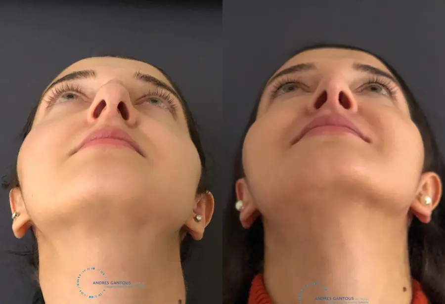 Rhinoplasty: Patient 9 - Before and After 2