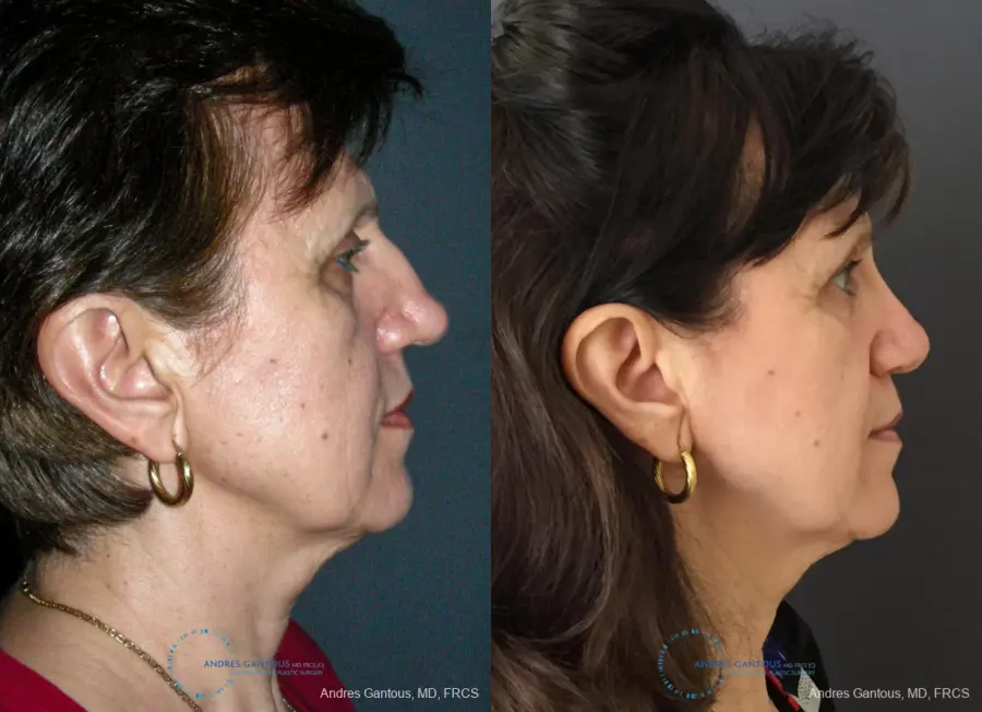Rhinoplasty: Patient 95 - Before and After 5