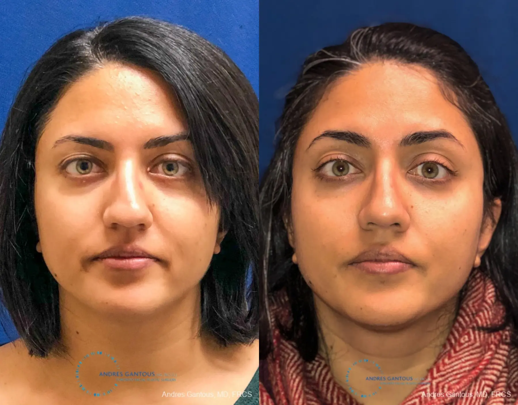 Rhinoplasty: Patient 80 - Before and After 1