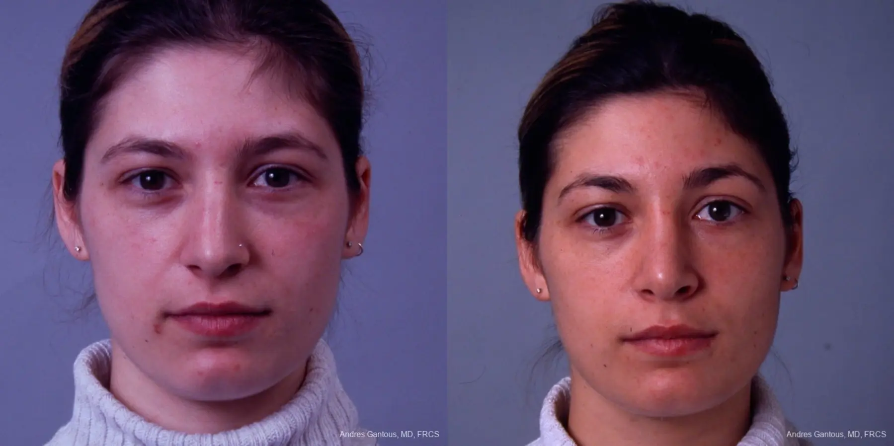 Rhinoplasty: Patient 32 - Before and After  