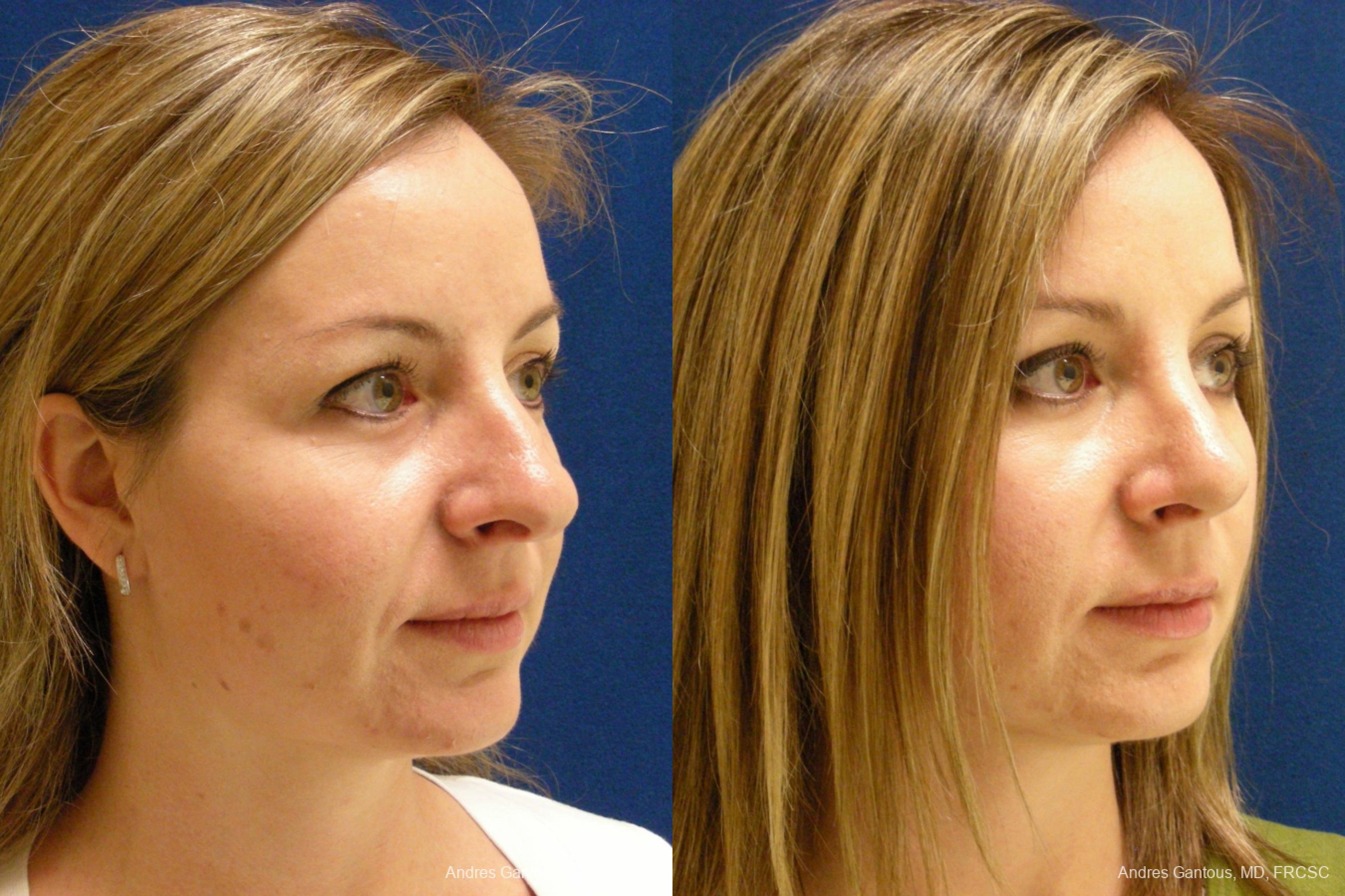 Rhinoplasty - Thumbnail 2