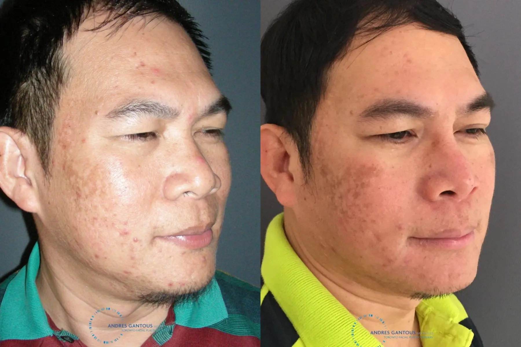 Rhinoplasty: Patient 61 - Before and After 3