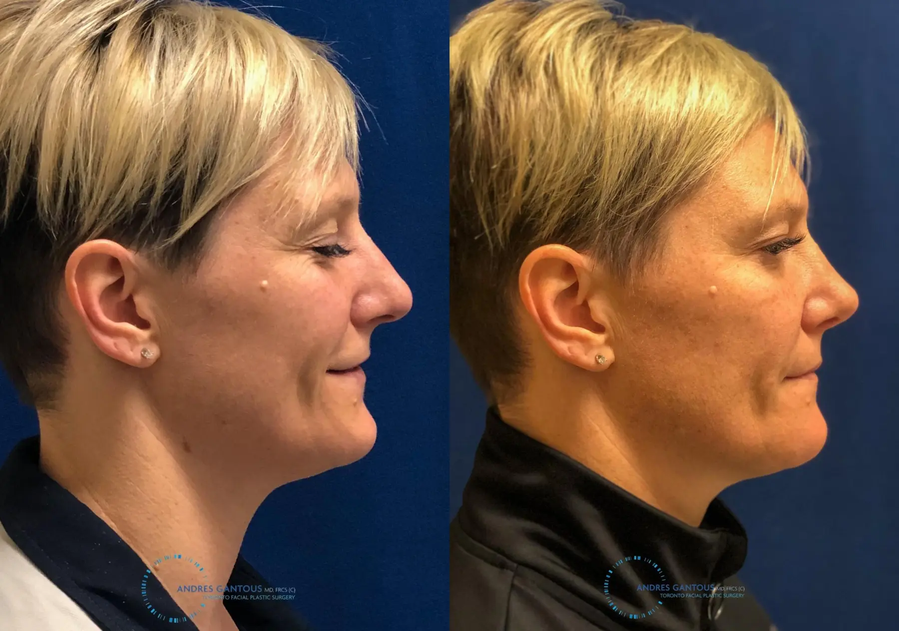 Rhinoplasty: Patient 68 - Before and After 5