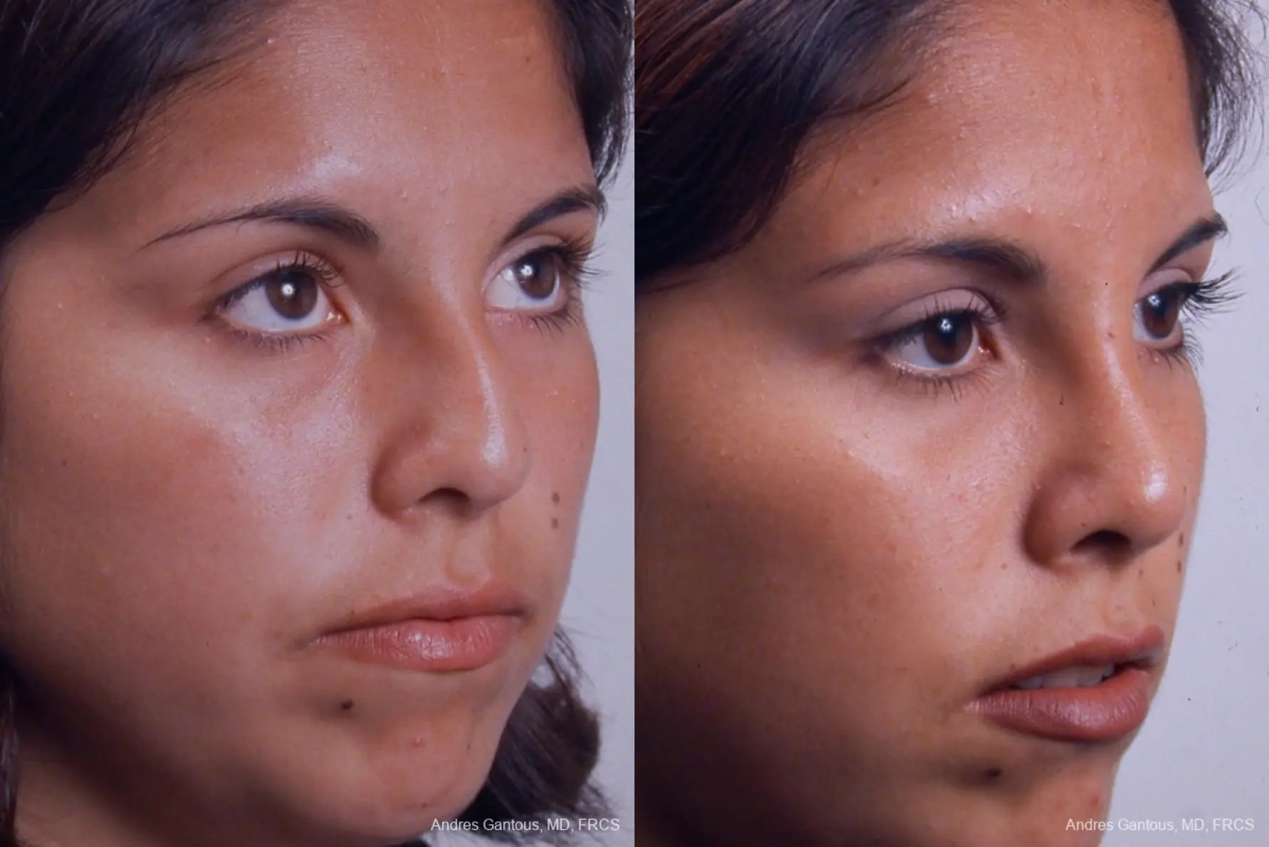 Rhinoplasty: Patient 19 - Before and After 2