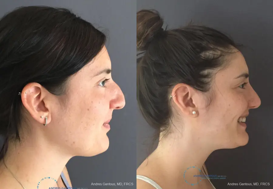 Rhinoplasty: Patient 83 - Before and After 5