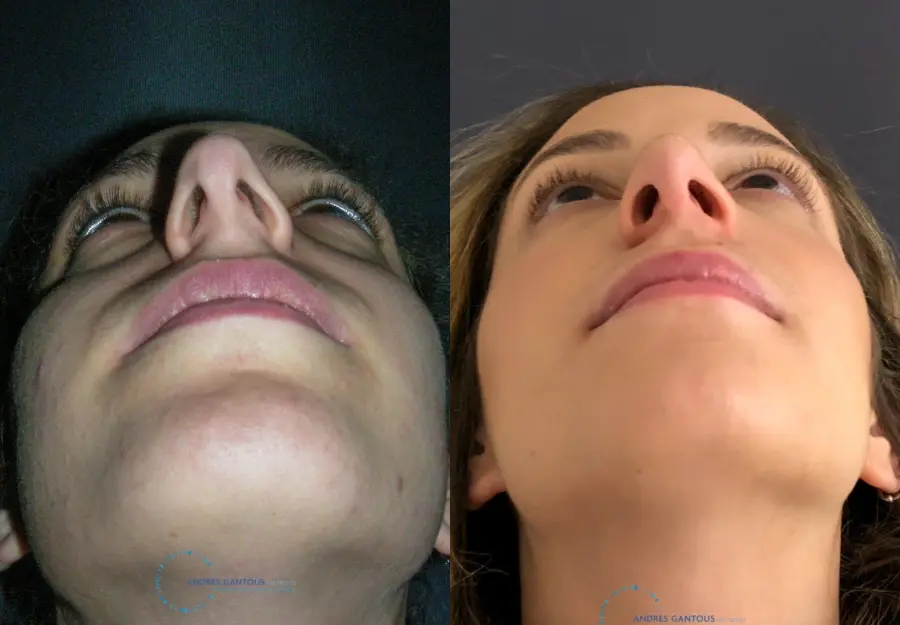 Rhinoplasty: Patient 72 - Before and After 2