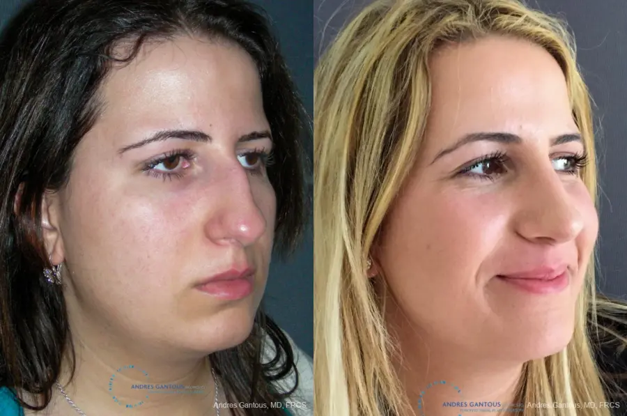 Rhinoplasty: Patient 92 - Before and After 3