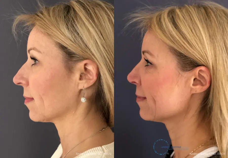 Rhinoplasty: Patient 15 - Before and After 6