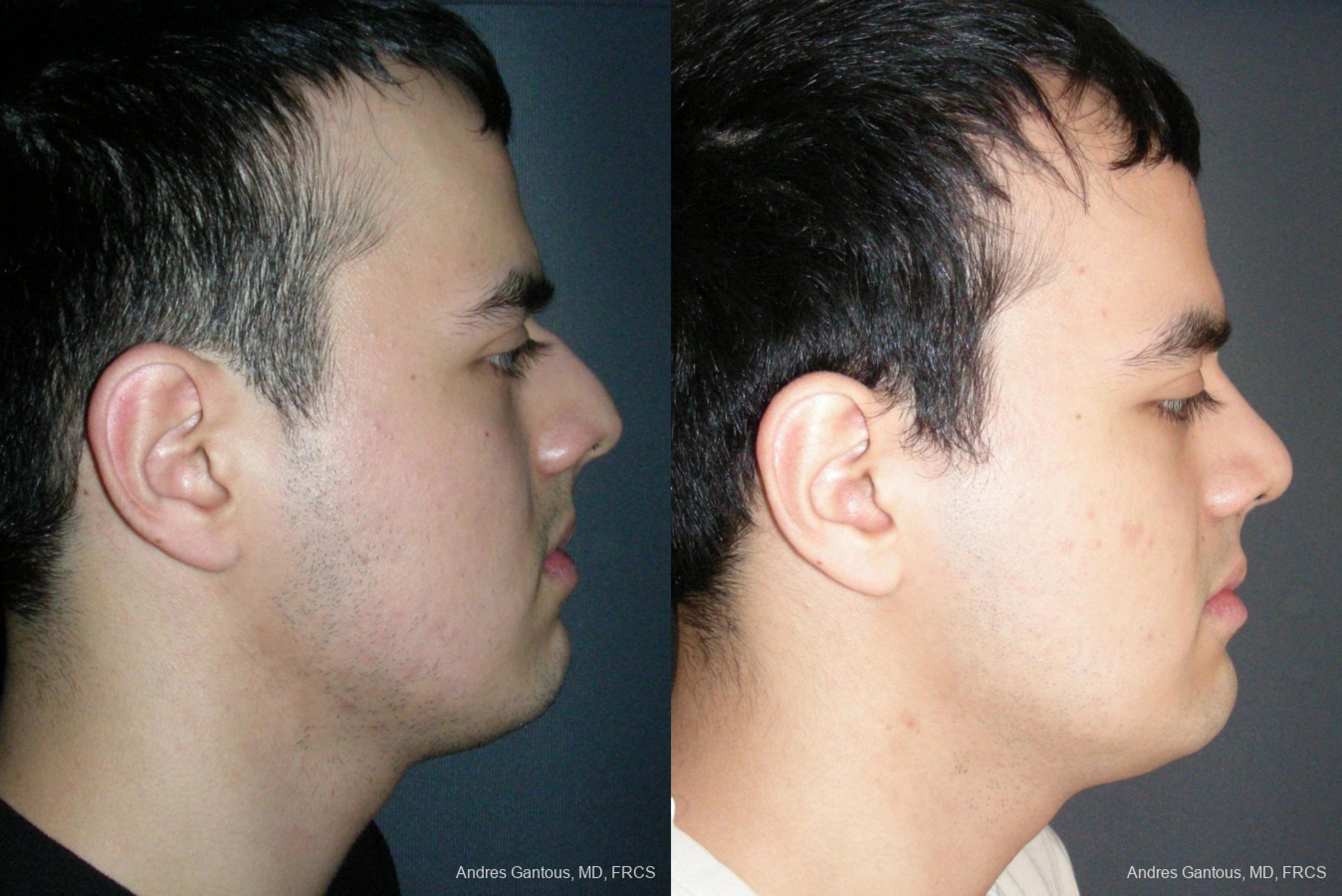 Rhinoplasty - Thumbnail 3