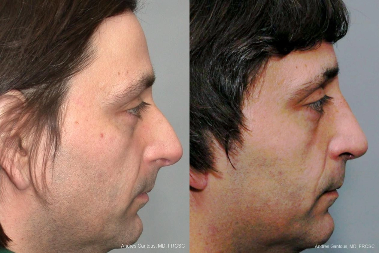 Rhinoplasty - Thumbnail 2