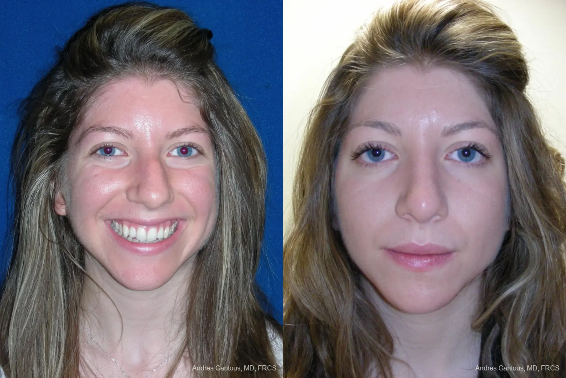 Rhinoplasty: Patient 50 - Before and After  