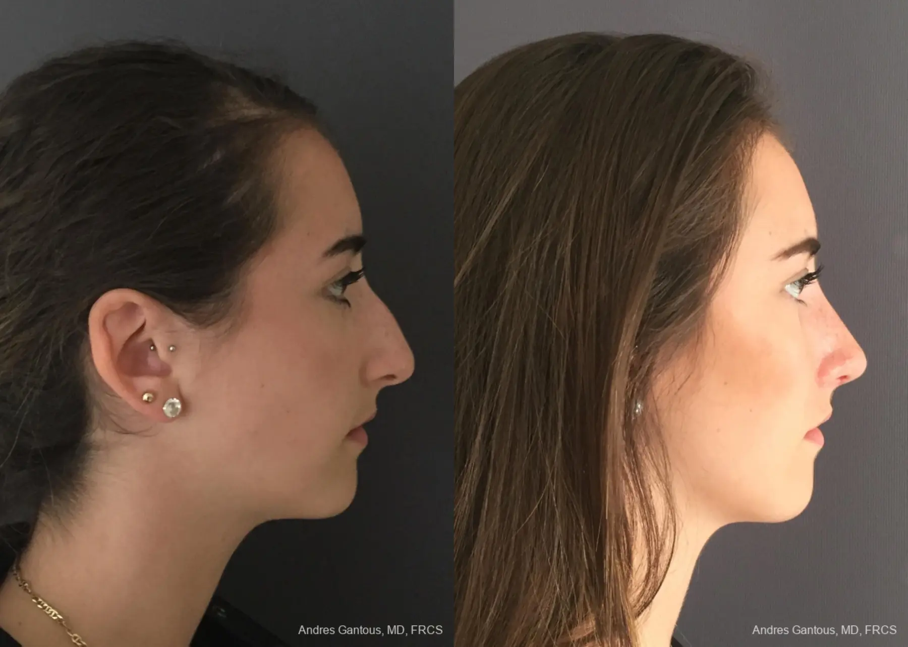 Rhinoplasty: Patient 95 - Before and After 5