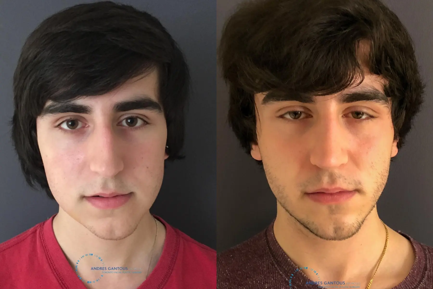 Rhinoplasty: Patient 65 - Before and After  