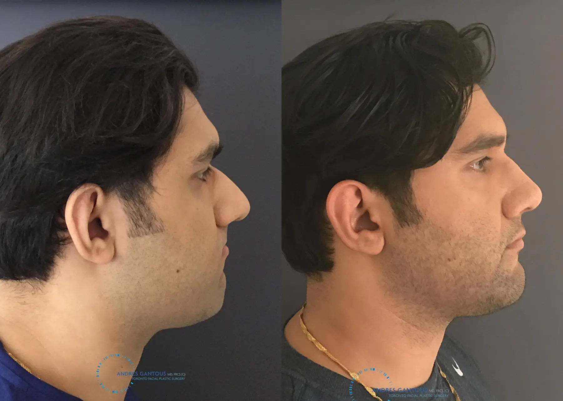 Rhinoplasty: Patient 62 - Before and After 5