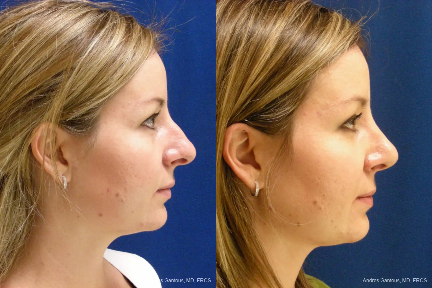 Rhinoplasty: Patient 27 - Before and After 4