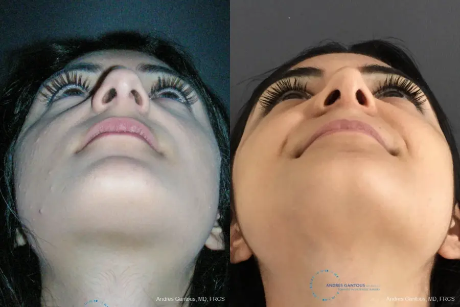 Rhinoplasty: Patient 87 - Before and After 2